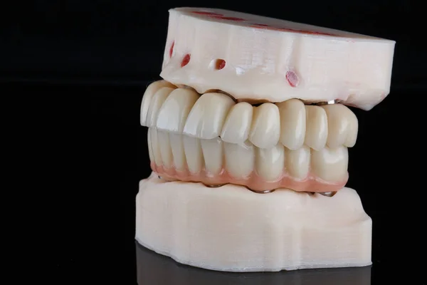 Modelo Dental Con Prótesis Ambas Mandíbulas Sobre Fondo Negro — Foto de Stock