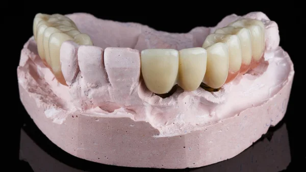 Δύο Τεχνητά Άκρα Τεχνητή Τσίχλα Στο Οδοντιατρικό Μοντέλο — Φωτογραφία Αρχείου