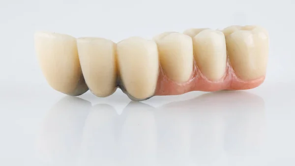 Prótesis Dental Con Encía Artificial Para Prótesis Mandíbula Mascar Honor —  Fotos de Stock