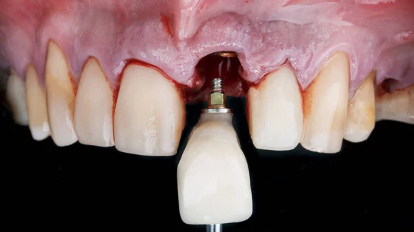 着床後の前歯冠の形成 — ストック写真