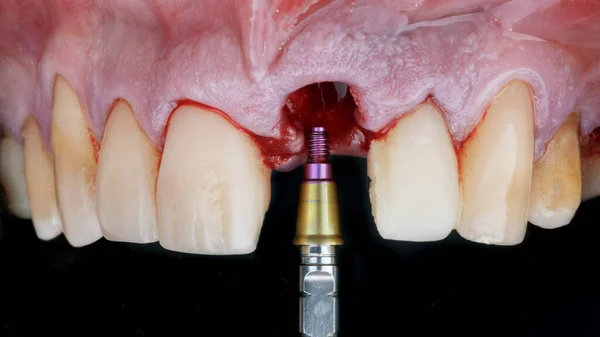 Montaż Podstawy Dentystycznej Zamiast Brakującego Przedniego Zęba Implantacji — Zdjęcie stockowe