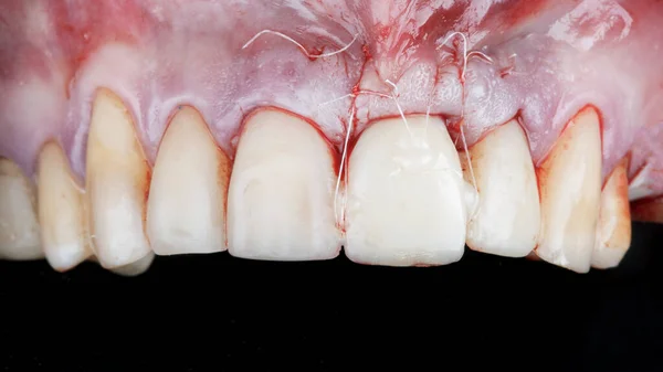 前歯の冠と復元するための縫合された歯茎を確立します — ストック写真
