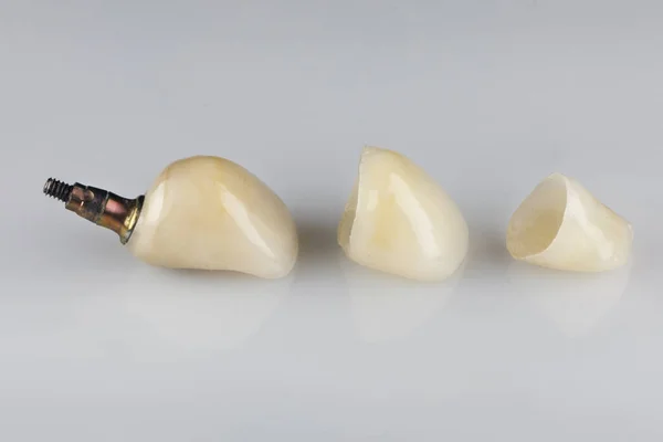 Classic Base Implant Crown — Stock Photo, Image