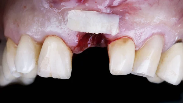 歯の前の歯茎に軟組織のフラップがあり — ストック写真