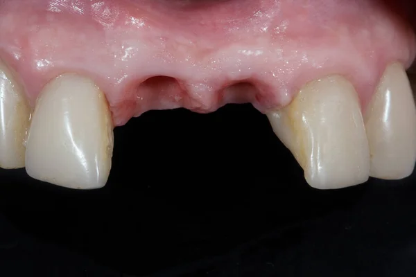 Guma Bez Dwóch Zębów Regeneracji — Zdjęcie stockowe