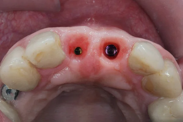 患者の歯茎と冠へのインプラントは — ストック写真