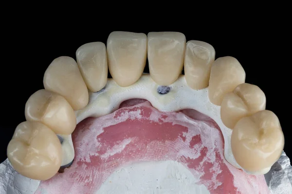 歯科用ビームとグラフェンクラウン — ストック写真