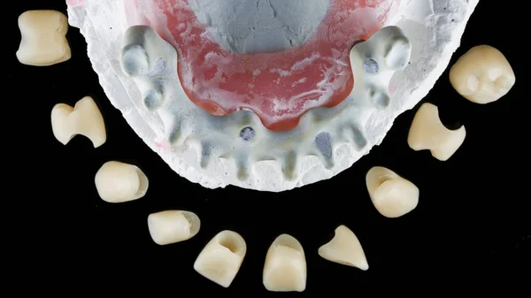 Modernas Coronas Grafeno Vigas Dentales Disparadas Desde Arriba Sobre Fondo —  Fotos de Stock