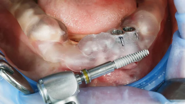 Şlemden Önce Diş Yapısı Diş Implantı — Stok fotoğraf