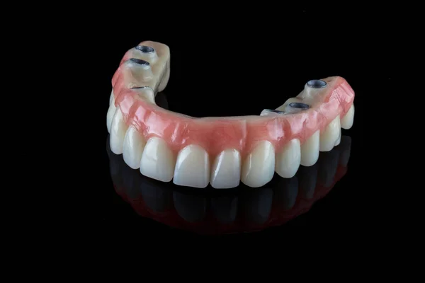 Prótese Mandíbula Superior Dentária Permanente Realista Para Paciente Anos Idade — Fotografia de Stock