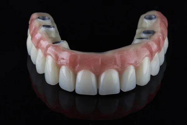 6本のインプラントを固定し 黒い背景で撮影した歯科上顎のプロテーゼ — ストック写真