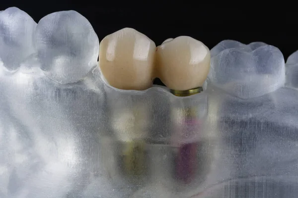Coroas Modelo Dental Feito Polímero Transparente — Fotografia de Stock