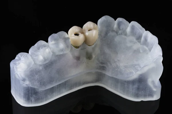 Diş Kaplamaları Hastanın Çenesinin Özel Bir Modelinde Içeriden Görünümü Olan — Stok fotoğraf