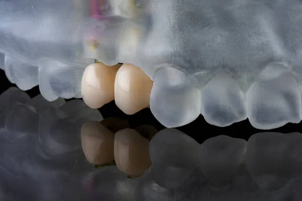 Οδοντιατρικές Κορώνες Εμφανίζονται Ένα Ειδικό Μοντέλο Για Την Ακρίβεια — Φωτογραφία Αρχείου