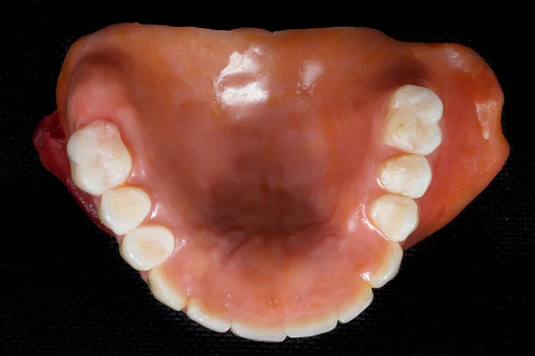 Dental Prosthesis Removable Top View Black Background — Stock Photo, Image