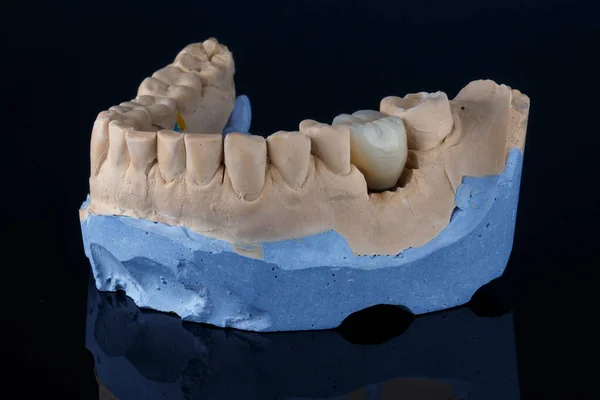 噛む歯のマニホールドモデルと歯冠 — ストック写真