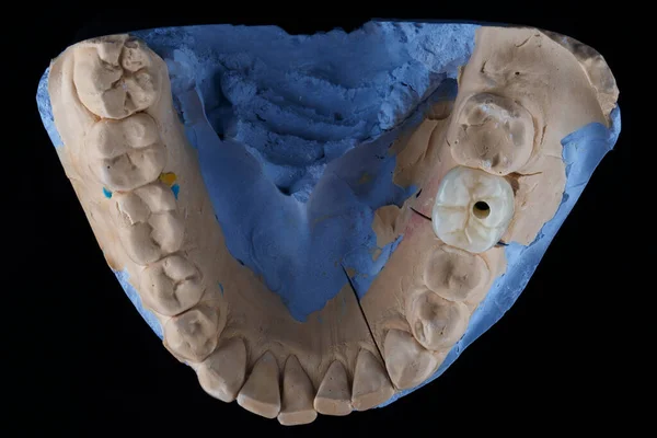 噛む歯の顎と歯冠のモデルブラック グラスの上からの眺め — ストック写真