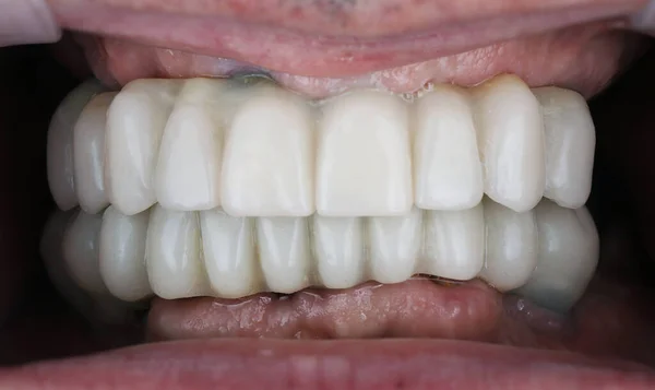 Utrwalone Protezy Dentystyczne Wykonane Polimeru Dużej Operacji Implantacji Natychmiastowym Załadunku — Zdjęcie stockowe