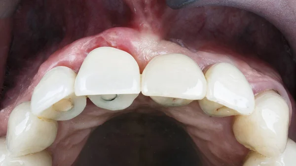 Estabeleceu Várias Coroas Dentárias Imediatamente Após Implantação Posterior Restauração Das — Fotografia de Stock