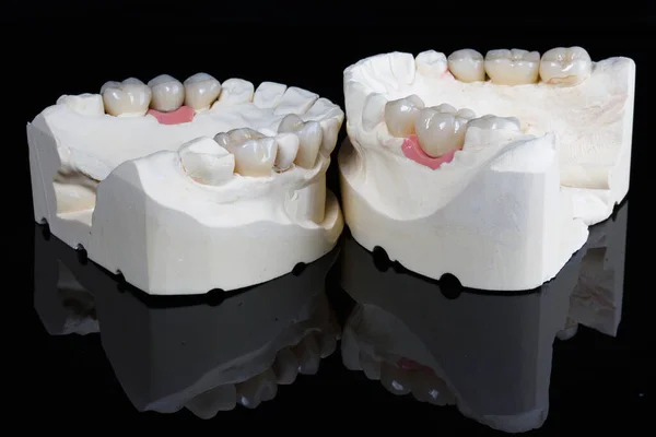 Corona Dental Modelo Para Precisión Disparo Sobre Fondo Negro — Foto de Stock