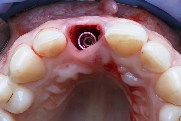 Excelente Quadro Implante Dentário Instalado Vista Gengiva Antes Adicionar Tecido — Fotografia de Stock