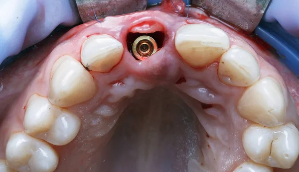 Implante Encía Del Incisivo Anterior Foto Dental Especial —  Fotos de Stock