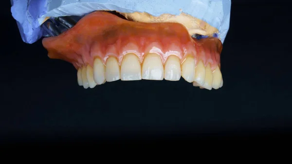 チタン製の上顎に人工歯を装着した人工歯列 黒い背景の上からの眺め — ストック写真
