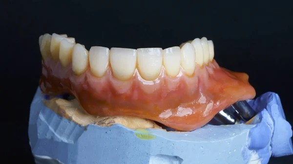 Artificial Limb Prosthesis Titanium Beams Upper Jaw — Stock Photo, Image