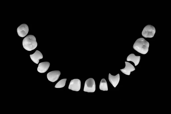 Compositie Van Keramische Tandheelkundige Fineer Vorm Van Een Glimlach Een — Stockfoto