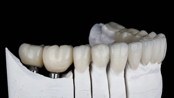 Modelo Dental Com Coroas Cerâmica Folheados Brancos Sobre Fundo Preto — Fotografia de Stock