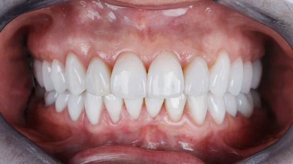 セラミック製の通気口のある美しい歯が — ストック写真