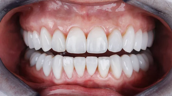 Piękne Zęby Ceramicznymi Okleinami Górnych Dolnych Szczęk Pacjenta — Zdjęcie stockowe