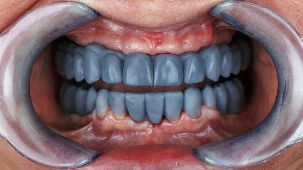 歯のワックスを青い2本の顎で診断し義肢を作成します — ストック写真