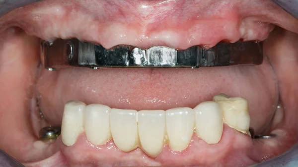 Barre Titane Dentaire Mâchoire Supérieure Dans Cavité Gingivale Patient — Photo