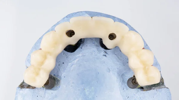 Prótese Dentária Temporária Mandíbula Superior Sobre Modelo Tirada Cima Sobre — Fotografia de Stock
