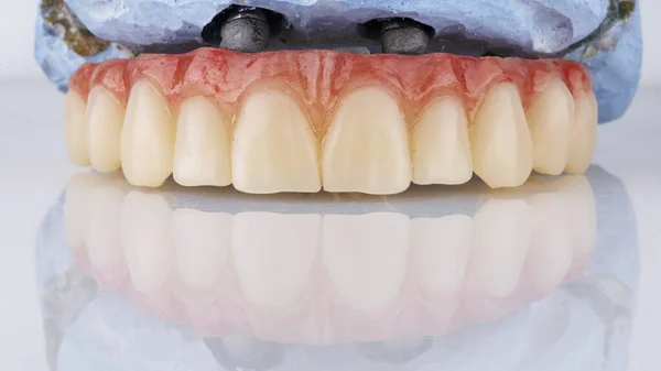Зубной Протез Верхней Челюсти Гипсовой Модели Снятый Белом Фоне Отражением — стоковое фото