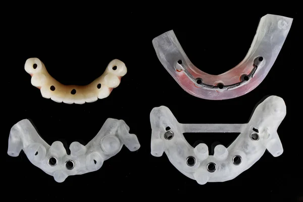 Conjunto Barras Plantillas Prótesis Para Implantes Dentales Grandes Prótesis — Foto de Stock