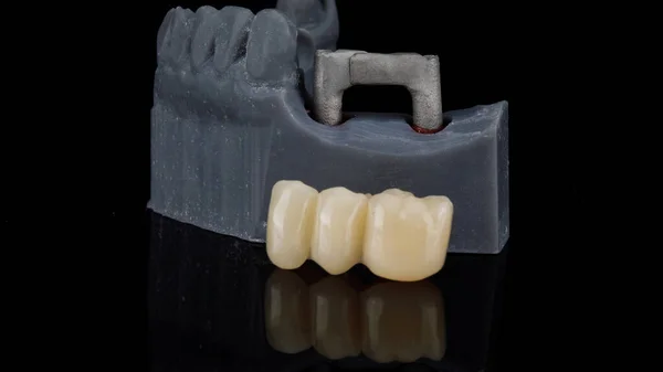 Temporary Dental Bridge Model Beam Black Background — Stock Photo, Image