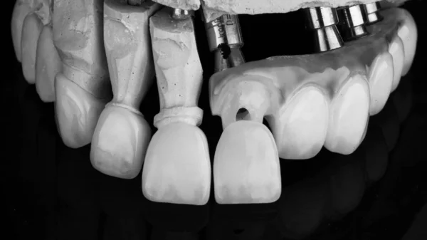 Dental Veneers Made Ceramic Incisors Bridge Gingiva Made Ceramic Black — Stock Photo, Image