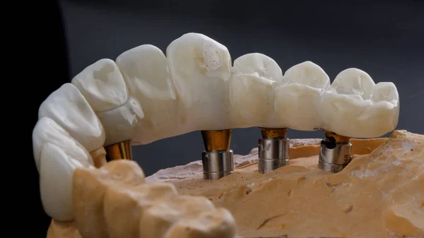 Kompozycja Mostu Dentystycznego Koron Ceramicznych Modelu Gipsowym — Zdjęcie stockowe