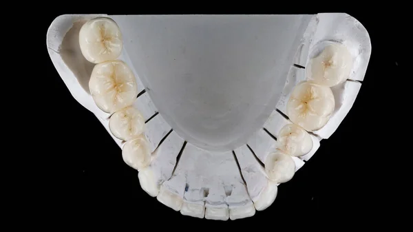 Folheados Dentários Feitos Cerâmica Modelo Mandíbula Inferior Filmados Cima Fundo — Fotografia de Stock