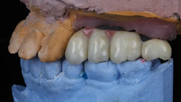 Ponte Zircônio Para Dentes Mastigadores Mandíbula Modelo Mordida — Fotografia de Stock