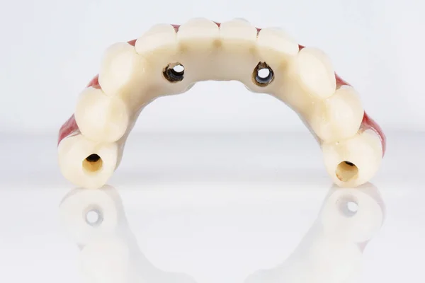 Перевернутий Зубний Протез Верхньої Щелепи Полімерних Металевих Смуг Білому Тлі — стокове фото