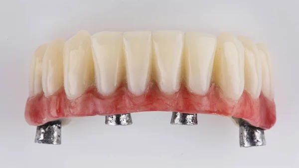 Excelente Prótese Dentária Temporária Com Goma Rosa Para Mandíbula Inferior — Fotografia de Stock