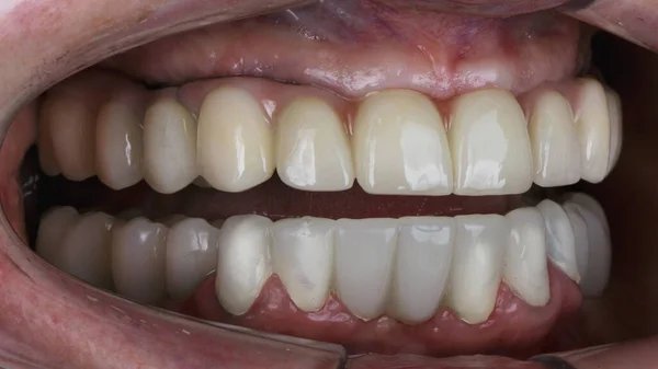 口腔と歯冠の上のセラミック製の義歯 — ストック写真