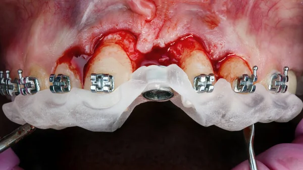 Merkezi Implantasyon Için Cerrahi Şablon Diş Telleri — Stok fotoğraf