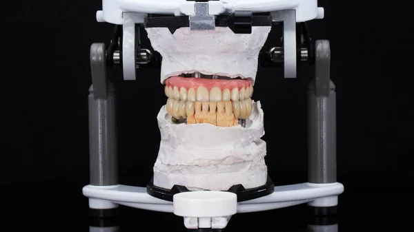 ピンクの歯茎とセラミックの冠が関節鏡のモデルに — ストック写真