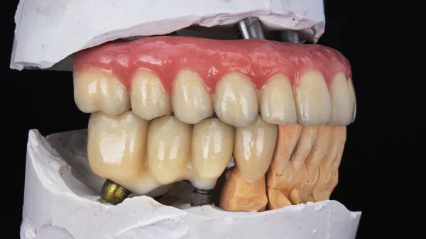 金属セラミック製の上顎の歯科補綴物と模型上のセラミック製の橋のマクロ写真 — ストック写真