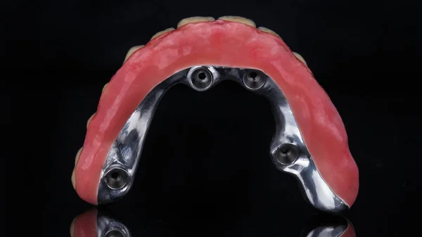 Titanium Bar Pink Gum Prosthesis — Stock Photo, Image