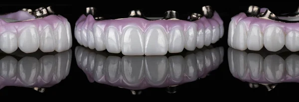 Dentiera Realizzata Zircone Dentale Alta Qualità Con Barra Titanio Collage — Foto Stock